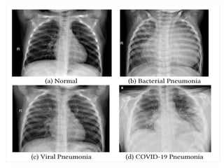 PNEUMONIA A CLINICAL APPROACH AND MANAGEMENT | PPTX
