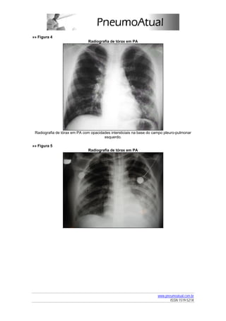 »» Figura 4
                               Radiografia de tórax em PA




 Radiografia de tórax em PA com opacidades intersticiais na base do campo pleuro-pulmonar
                                       esquerdo.

»» Figura 5
                               Radiografia de tórax em PA




                                                                      www.pneumoatual.com.br
                                                                             ISSN 1519-521X
 