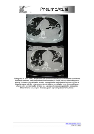 Radiografia de tórax em PA de paciente com pneumonia estafilocócica mostrando opacidades
 alveolares bilaterais, mais extensas na metade inferior do campo pleuropulmonar esquerdo.
 Nota-se a presença de cavidades também bilateralmente. A tomografia computadorizada de
  tórax (janela de pulmão) mostra com maiores detalhes os múltiplos focos de consolidação,
    alguns deles com cavitação. Embora não seja a janela ideal, as opacidades localizadas
          bilateralmente nas porções dorsais sugerem a presença de derrame pleural.




                                                                      www.pneumoatual.com.br
                                                                             ISSN 1519-521X
 