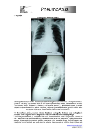 »» Figura 6
                                 Radiografia de tórax em PA




  Radiografia de tórax em PA mostra opacidade homogênea obscurecendo a margem cardíaca
 (sinal da silhueta), o que fala a favor de sua localização em lobo médio. Há obliteração do seio
 costo-frênico direito, sugerindo a presença de derrame pleural (1). A incidência lateral mostra a
imagem projetando-se sobre a área cardíaca, confirmando sua localização no lobo médio, além
                   do pequeno derrame pleural evidenciado posteriormente (2).

18 - Como fazer, então, quando não se dispõe de radiografia de tórax para avaliação de
paciente com suspeita clínica de pneumonia adquirida na comunidade (PAC)?
Conforme já comentado, a radiografia de tórax é indispensável para o diagnóstico correto da
PAC, além de trazer informações importantes em relação à sua gravidade. Excepcionalmente,
quando é realmente impossível fazê-la, o paciente com suspeita clínica de PAC deverá ser
tratado da forma habitual, que será descrita adiante. Na presença de critérios de gravidade, ele
                                                                            www.pneumoatual.com.br
                                                                                   ISSN 1519-521X
 
