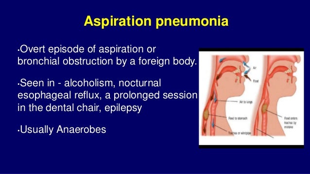 Pneumonia