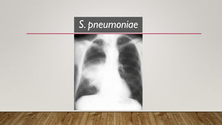 PneumoniaComunitaria_Bernardo.pdf pneumonia adquirida na comunidade | PDF