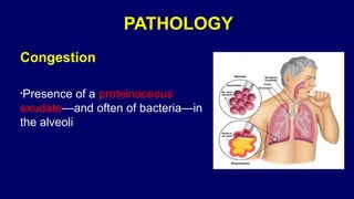 Pneumonia management protocol Dr. Govinda | PPTX