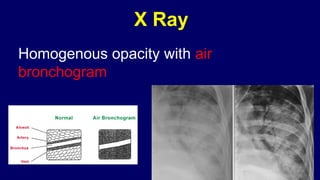 Pneumonia management protocol Dr. Govinda | PPTX