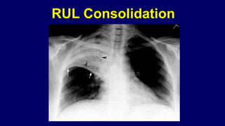 Pneumonia management protocol Dr. Govinda | PPTX