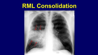Pneumonia management protocol Dr. Govinda | PPTX