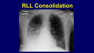 Pneumonia management protocol Dr. Govinda | PPTX