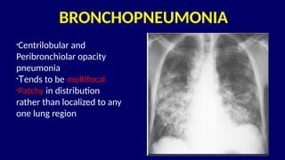 Pneumonia management protocol Dr. Govinda | PPTX