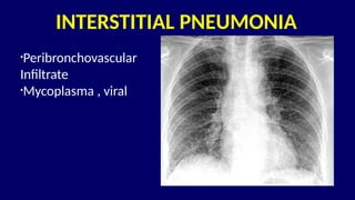 Pneumonia management protocol Dr. Govinda | PPTX