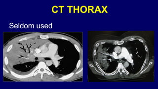 Pneumonia management protocol Dr. Govinda | PPTX