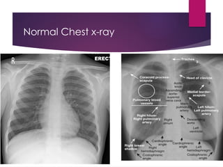 Normal Chest x-ray
 