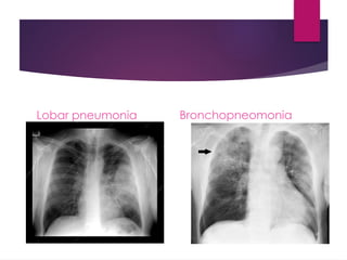 Lobar pneumonia Bronchopneomonia
 