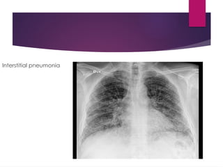 Interstitial pneumonia
 