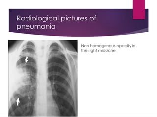 Radiological pictures of
pneumonia
Non homogenous opacity in
the right mid-zone
 