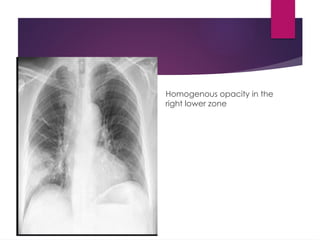 Homogenous opacity in the
right lower zone
 