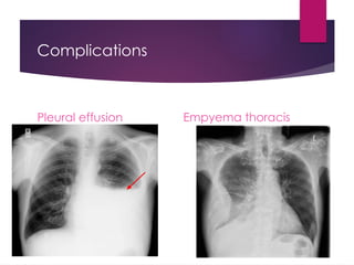 Complications
Pleural effusion Empyema thoracis
 