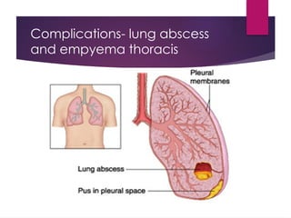 Complications- lung abscess
and empyema thoracis
 