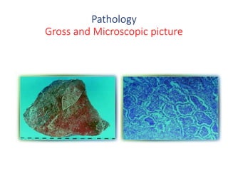 Pathology
Gross and Microscopic picture
 