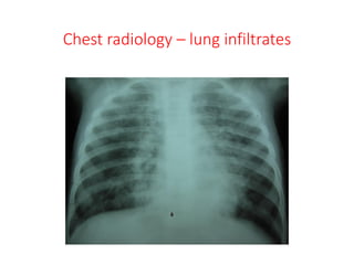Chest radiology – lung infiltrates
 