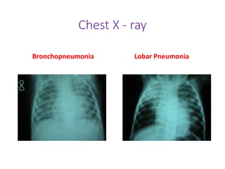 Chest X - ray
Bronchopneumonia Lobar Pneumonia
 