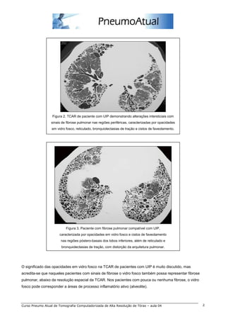 Figura 2. TCAR de paciente com UIP demonstrando alterações intersticiais com
                  sinais de fibrose pulmonar nas regiões periféricas, caracterizadas por opacidades
                  em vidro fosco, reticulado, bronquiolectasias de tração e cistos de faveolamento.




                           Figura 3. Paciente com fibrose pulmonar compatível com UIP,
                       caracterizada por opacidades em vidro fosco e cistos de faveolamento
                        nas regiões póstero-basais dos lobos inferiores, além de reticulado e
                        bronquiolectasias de tração, com distorção da arquitetura pulmonar.




O significado das opacidades em vidro fosco na TCAR de pacientes com UIP é muito discutido, mas
acredita-se que naqueles pacientes com sinais de fibrose o vidro fosco também possa representar fibrose
pulmonar, abaixo da resolução espacial da TCAR. Nos pacientes com pouca ou nenhuma fibrose, o vidro
fosco pode corresponder a áreas de processo inflamatório ativo (alveolite).




Curso Pneumo Atual de Tomografia Computadorizada de Alta Resolução de Tórax – aula 04                     2
 
