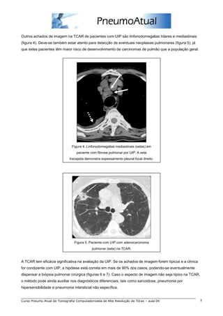 Outros achados de imagem na TCAR de pacientes com UIP são linfonodomegalias hilares e mediastinais
(figura 4). Deve-se também estar atento para detecção de eventuais neoplasias pulmonares (figura 5), já
que estes pacientes têm maior risco de desenvolvimento de carcinomas de pulmão que a população geral.




                               Figura 4. Linfonodomegalias mediastinais (setas) em
                                  paciente com fibrose pulmonar por UIP. A seta
                             tracejada demonstra espessamento pleural focal direito.




                                Figura 5. Paciente com UIP com adenocarcinoma
                                           pulmonar (seta) na TCAR.


A TCAR tem eficácia significativa na avaliação da UIP. Se os achados de imagem forem típicos e a clínica
for condizente com UIP, a hipótese está correta em mais de 90% dos casos, podendo-se eventualmente
dispensar a biópsia pulmonar cirúrgica (figuras 6 e 7). Caso o aspecto de imagem não seja típico na TCAR,
o método pode ainda auxiliar nos diagnósticos diferenciais, tais como sarcoidose, pneumonia por
hipersensibilidade e pneumonia intersticial não específica.


Curso Pneumo Atual de Tomografia Computadorizada de Alta Resolução de Tórax – aula 04                      3
 