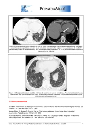 Figura 6. Paciente com achados clássicos de UIP na TCAR, com alterações intersticiais e sinais de fibrose nas bases,
  caracterizados por opacidades em vidro fosco, reticulado, espessamentos septais e bronquiolectasias de tração. O
paciente era portador de esclerodermia (a seta aponta para dilatação esofágica na TCAR) e não foi necessário realizar
                                             biopsia pulmonar cirúrgica.




Figura 7. Alterações intersticiais nos lobos inferiores de paciente em uso de amiodarona. Pneumonia intersticial usual,
 caracterizada por opacidades em vidro fosco, espessamentos septais irregulares e bronquiolectasias de tração com
                                            distorção da arquitetura pulmonar.


3 - Leitura recomendada


ATS/ERS International multidisciplinary consensus classification of the idiopathic interstitial pneumonias. Am
J Respir Crit Care Med 2002;165:277-304.
Mueller-Mang C, Grosse C, Schmid K et al. What every radiologist should know about interstitial
pneumonias. RadioGraphics 2007;27:595–615.
Hunninghake GW, Zimmerman MB, Schwartz DA. Utility of a lung biopsy for the diagnosis of idiopathic
pulmonary fibrosis. Am J Respir Crit Care Med 2001;164:193-196.



Curso Pneumo Atual de Tomografia Computadorizada de Alta Resolução de Tórax – aula 04                                 4
 