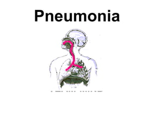 Pneumonia
 