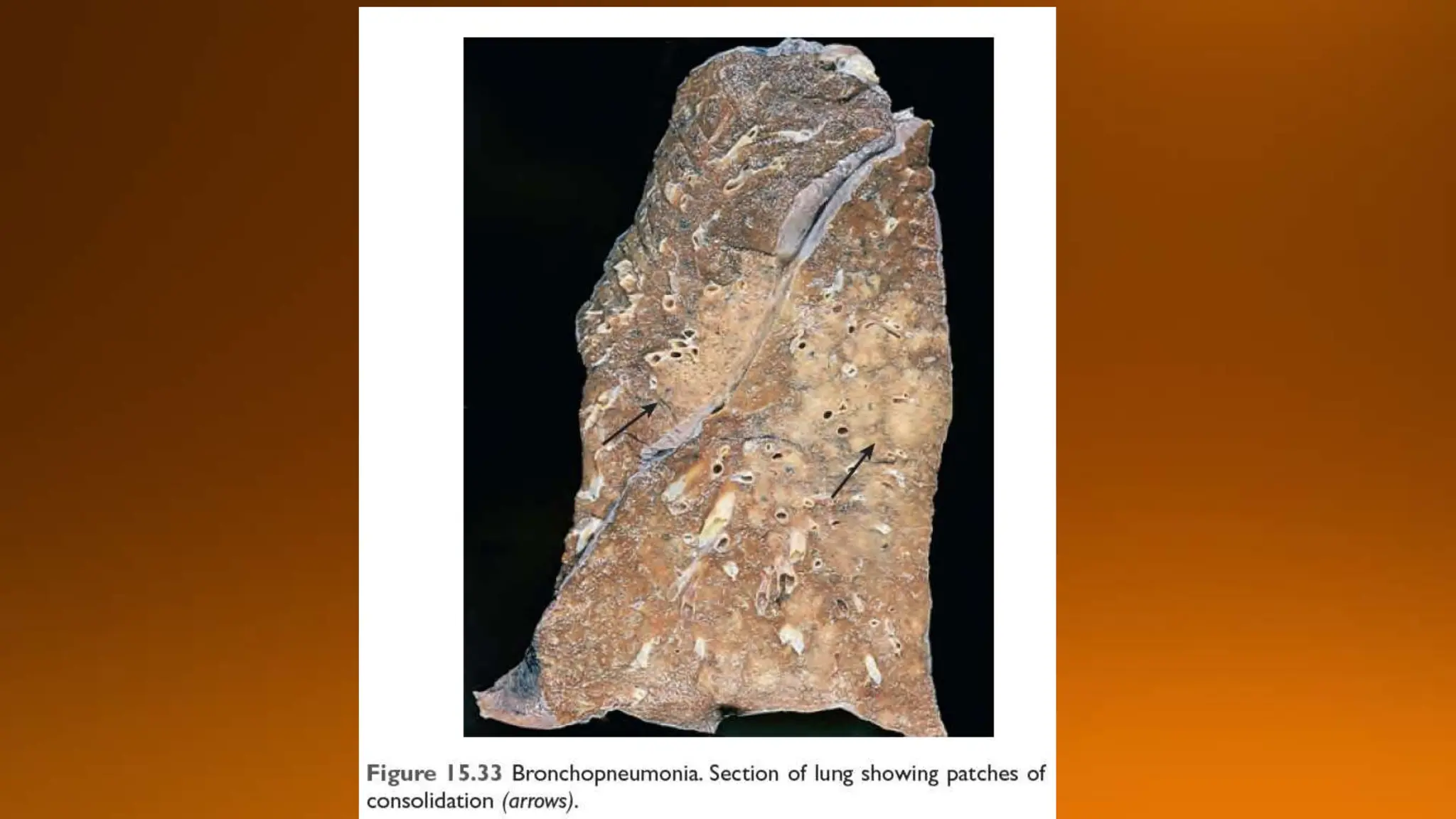 Pneumonia presentation peads unit ii children hospital larkana.pptx