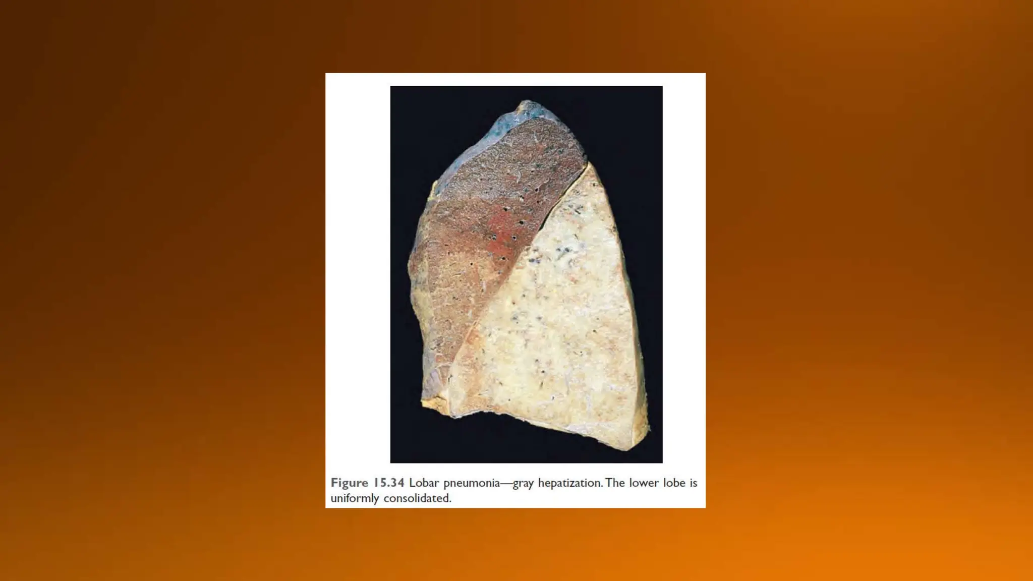 Pneumonia presentation peads unit ii children hospital larkana.pptx