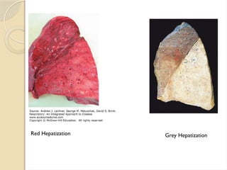 Red Hepatization Grey Hepatization
 