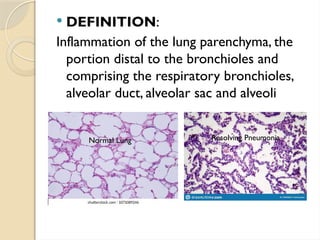  DEFINITION:
Inflammation of the lung parenchyma, the
portion distal to the bronchioles and
comprising the respiratory bronchioles,
alveolar duct, alveolar sac and alveoli
Normal Lung Resolving Pneumonia
 