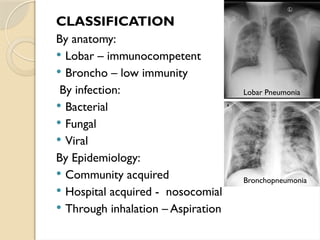 CLASSIFICATION
By anatomy:
 Lobar – immunocompetent
 Broncho – low immunity
By infection:
 Bacterial
 Fungal
 Viral
By Epidemiology:
 Community acquired
 Hospital acquired - nosocomial
 Through inhalation – Aspiration
Lobar Pneumonia
Bronchopneumonia
 