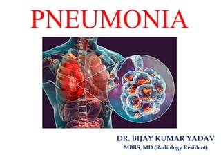 PNEUMONIA
DR. BIJAY KUMAR YADAV
MBBS, MD (Radiology Resident)
 