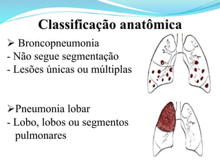 Ø Broncopneumonia
- Não segue segmentação
- Lesões únicas ou múltiplas
Ø Pneumonia lobar
- Lobo, lobos ou segmentos
pulmonares
Classificação anatômica
 