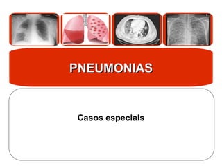 PNEUMONIAS
PNEUMONIAS
Casos especiais
 