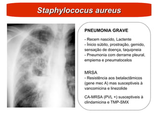 Staphylococus aureus
Staphylococus aureus
PNEUMONIA GRAVE
- Recem nascido, Lactente
- Ínicio súbito, prostração, gemido,
sensação de doença, taquipneia
- Pneumonia com derrame pleural,
empiema e pneumatocelos
MRSA
- Resistência aos betalactâmicos
(gene mec A) mas susceptiveis à
vancomicina e linezolide
CA-MRSA (PVL +) susceptiveis à
clindamicina e TMP-SMX
 