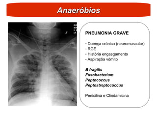 Anaeróbios
Anaeróbios
PNEUMONIA GRAVE
- Doença crónica (neuromuscular)
- RGE
- História engasgamento
- Aspiraçõa vómito
B fragilis
Fusobacterium
Peptococcus
Peptostreptococcus
Penicilina e Clindamicina
 