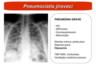 Pneumocistis jiroveci
Pneumocistis jiroveci
PNEUMONIA GRAVE
- HIV
- IDPrimaria
- Imunosupressores
- Malnutrição
Diarreia crónica; perda peso
Dispneia grave
Hipoxemia
TMP-SMX, Corticoides,
Ventilação mecãnica precoce
 