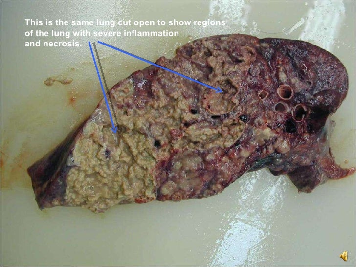 BACTERIAL PNEUMONIA BY DR BASHIR AHMED DAR ASSOCIATE PROFESSOR MEDICI…