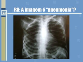 RX: A imagem é “pneumonia”? 