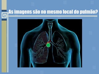 As imagens são no mesmo local do pulmão?  