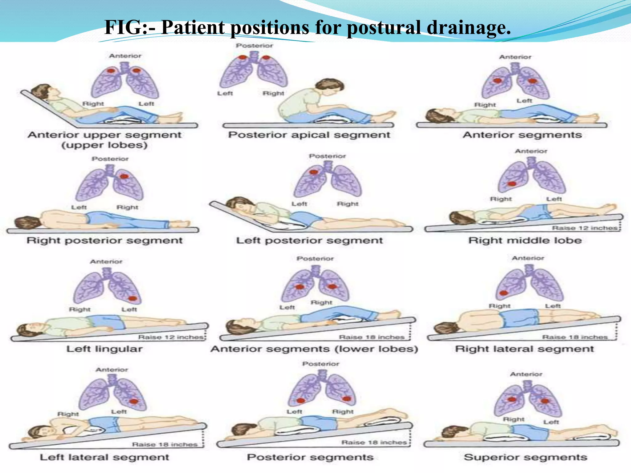 Postural Shift Pneumonia seminar presentaation | PPTX