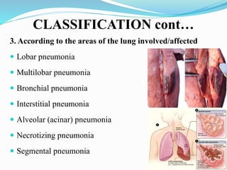 CLASSIFICATION cont…
3. According to the areas of the lung involved/affected
 Lobar pneumonia
 Multilobar pneumonia
 Bronchial pneumonia
 Interstitial pneumonia
 Alveolar (acinar) pneumonia
 Necrotizing pneumonia
 Segmental pneumonia
 