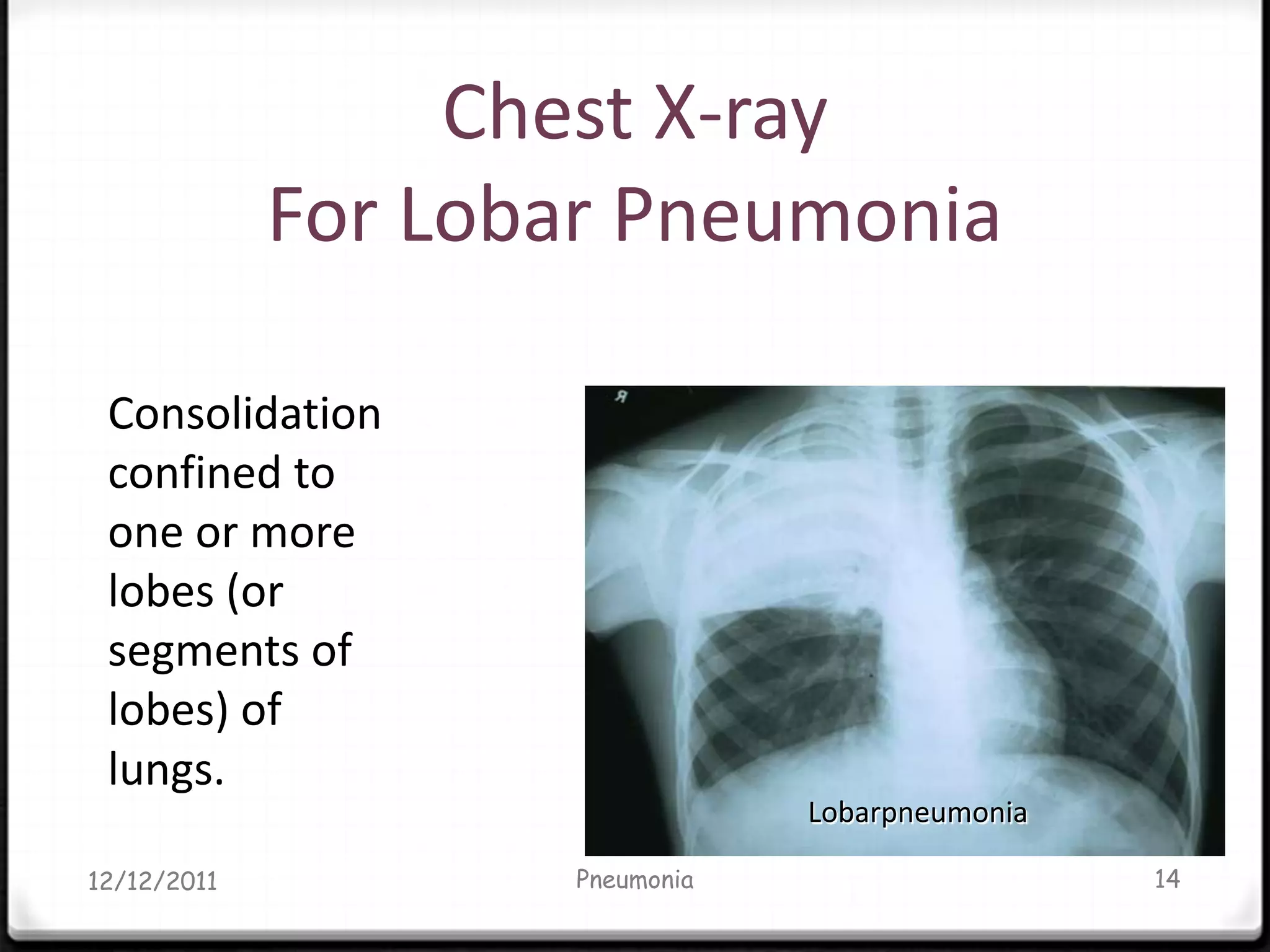 Chest X-ray
             For Lobar Pneumonia

 Consolidation
 confined to
 one or more
 lobes (or
 segments of
 lobes) of
 lungs.
                                Lobarpneumonia

12/12/2011          Pneumonia                    14
 