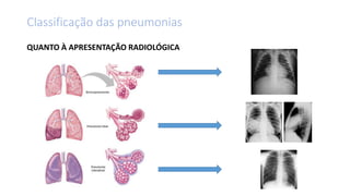 QUANTO À APRESENTAÇÃO RADIOLÓGICA
Classificação das pneumonias
 