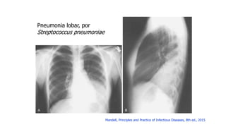 Pneumonia lobar, por
Streptococcus pneumoniae
Mandell, Principles and Practice of Infectious Diseases, 8th ed., 2015
 
