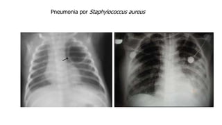 Pneumonia por Staphylococcus aureus
 