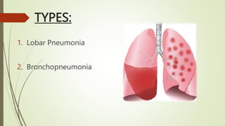 TYPES:
1. Lobar Pneumonia
2. Bronchopneumonia
 
