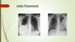 Lobar Pneumonia
 